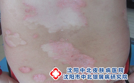 牛皮癣皮肤护理怎么做，沈阳市好点的牛皮癣医院