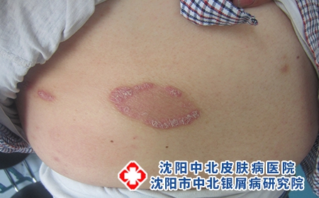 银屑病不同部位的症状表现，沈阳治银屑病有效的研究院