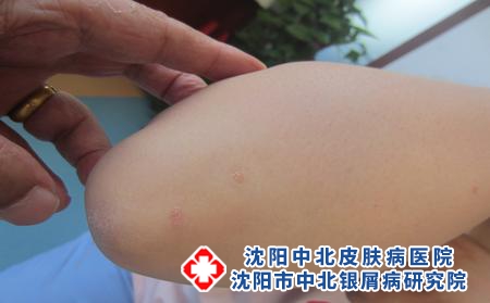 银屑病的高发人群是什么，沈阳那家专科医院专业