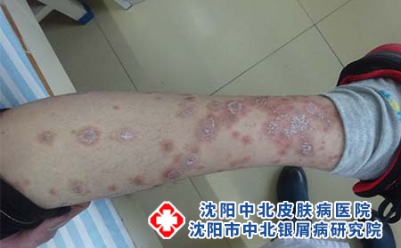 男性牛皮癣患者怎么护理，沈阳专业治疗牛皮癣医院