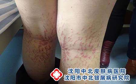 治疗牛皮肤癣的医院要怎么选择，沈阳的牛皮肤癣医院哪家好