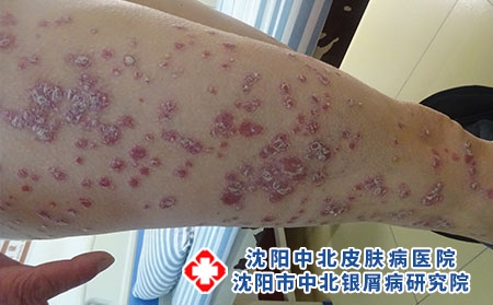 牛皮癣是怎么被引起的，沈阳那个医院看牛皮癣好?