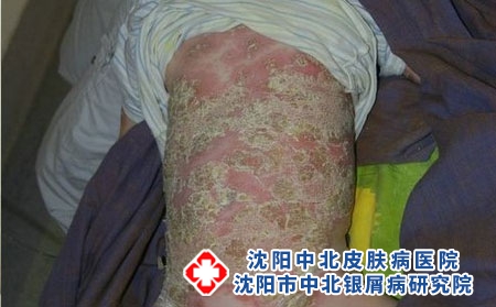 哪些食疗可以帮助我们治疗牛皮癣?沈阳哪家治疗牛皮癣较好