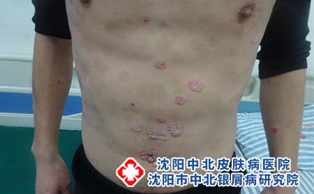 沈阳牛皮癣治疗用多少钱?牛皮癣如何预防?