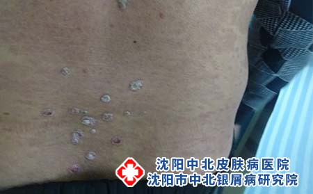 沈阳治疗牛皮癣的医院哪个效果好