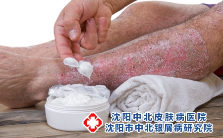 摄图网_502709980_皮丝虫病是皮肤慢发炎疾病（企业商用）