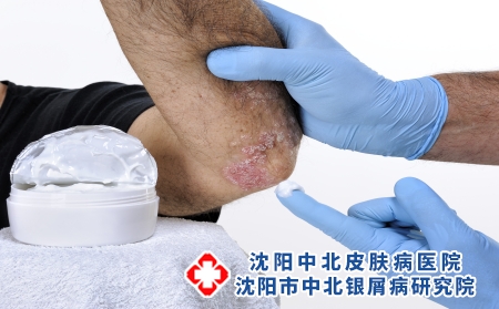 摄图网_503148875_用手套保护双手的皮肤科医生用乳膏治疗患有银屑病的成年男（企业商用）