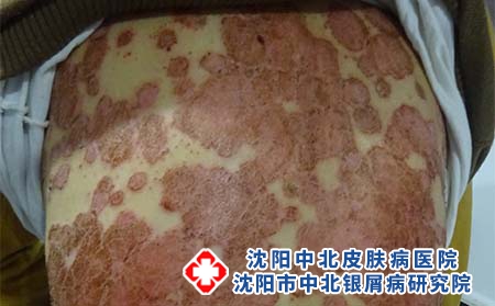 沈阳牛皮癣治疗去哪里?