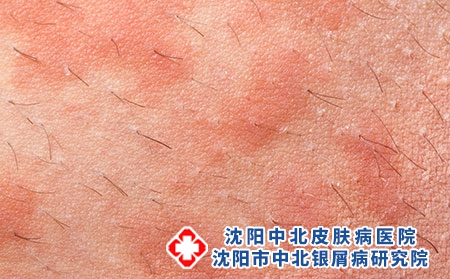 摄图网_303285488_Eczemaoti皮肤炎症状纹理（企业商用）