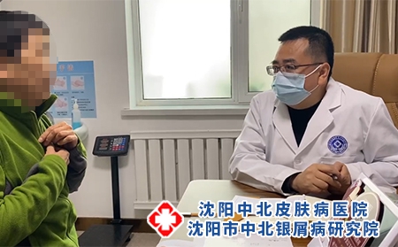 沈阳银屑病看哪好-沈阳牛皮癣医治医院