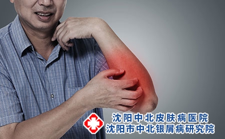 摄图网_401870392_皮肤红肿（企业商用）