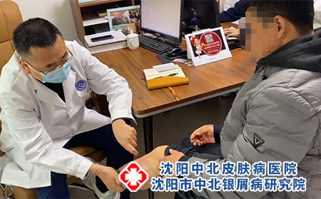 沈阳哪家治银屑病-沈阳市中北银屑病研究院-沈阳在哪治疗银屑病 沈阳哪家治银屑病-沈阳市中北银屑病研究院-沈阳在哪治疗银屑病