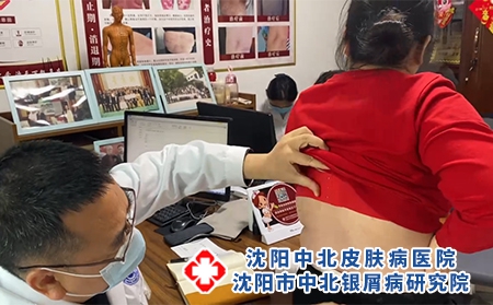 沈阳哪专治银屑病-沈阳中北银屑病研究院-沈阳治银屑病到哪好 沈阳哪专治银屑病-沈阳中北银屑病研究院-沈阳治银屑病到哪好