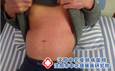 有银屑病要注意什么?专家详解:这3个关键点要明白