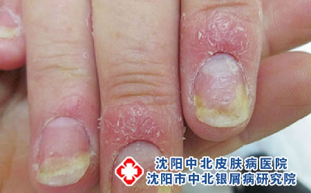 指甲牛皮癣1 指甲牛皮癣1