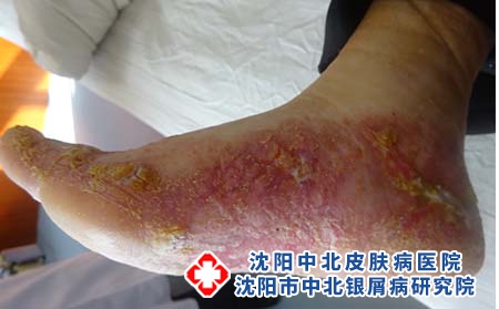 银屑病会自愈吗 身上刚长小红斑等着自己消靠谱吗