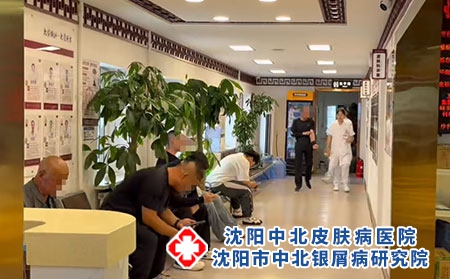 沈阳孙金奎诊疗牛皮癣 - 沈阳中北医院 沈阳孙金奎诊疗牛皮癣 - 沈阳中北医院