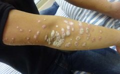 银屑病患者的饮食禁忌是什么