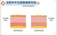 沈阳中北研究院揭秘：银屑病患者为何会产生大量“脱屑”