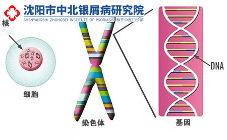 沈阳牛皮癣治疗医院,沈阳寻常型牛皮癣,沈阳哪里可以看牛皮癣