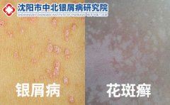 沈阳市中北银屑病治疗：牛皮癣和汗斑花斑癣的区别图片