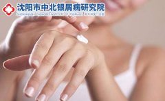 牛皮癣带来哪些具体危害?沈阳和平区治疗牛皮癣医院说