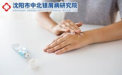 银屑病不治疗行不行?会有什么危害吗?辽宁沈阳看银屑病那家医院告诉你