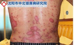 沈阳牛皮癣治疗医院：颈部牛皮癣复发是什么原因