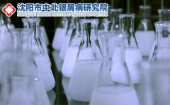 在辽宁沈阳检查银屑病费用大概要多少