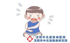 孩子脖子出现银屑病怎么回事