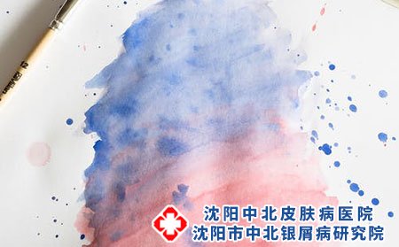 牛皮癣复发的原因是什么