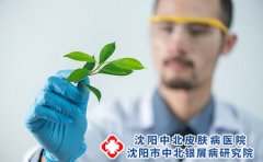 牛皮癣疾病可以用药物治疗好吗?