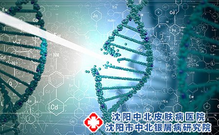 沈阳银屑病医院,辽宁银屑病专科医院,治疗牛皮癣的好方法
