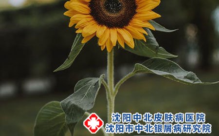 得了牛皮癣有什么症状?预防牛皮癣的措施有哪些?